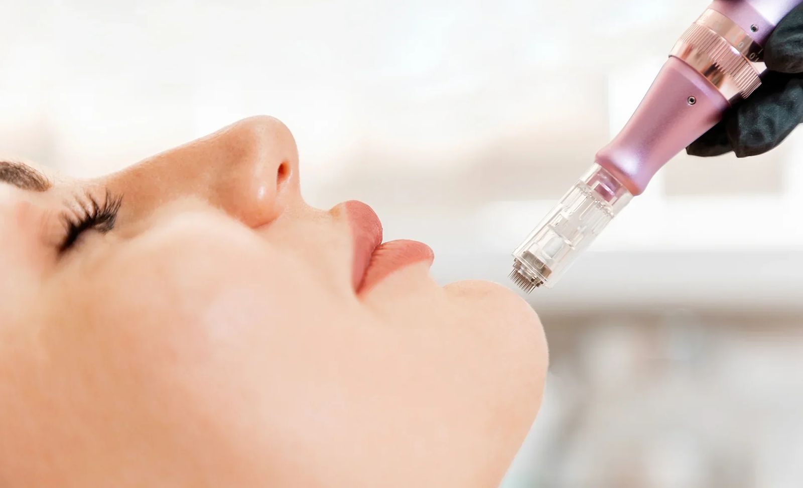 Soin Microneedling Ultra Précision à Clamart, chez KA Dépil